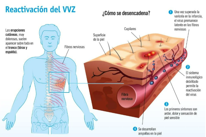 Zoster
